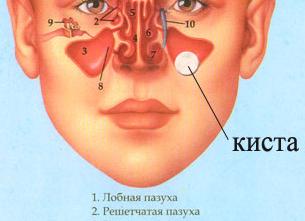 Киста в левой верхнечелюстной пазухи