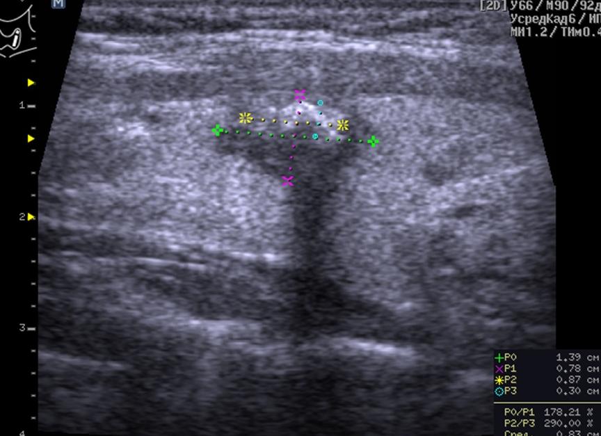 Кальцинированный узел щитовидной железы что это