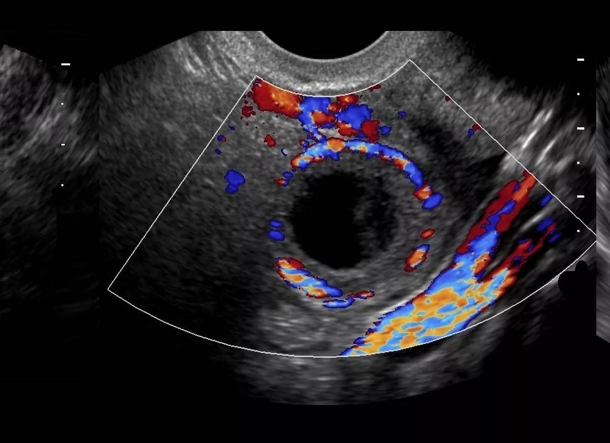 Как выглядит на узи желтое тело