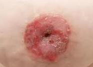 Инфильтративный рак молочной железы