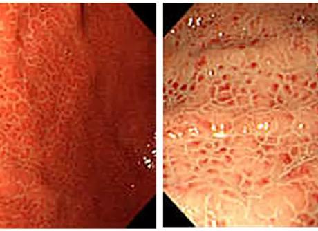 Эритематозная очаговая гастропатия