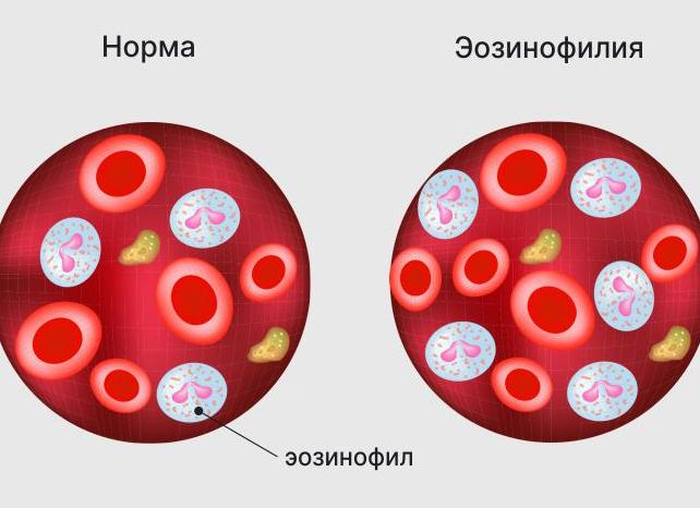 Эозинофилы повышены что это значит