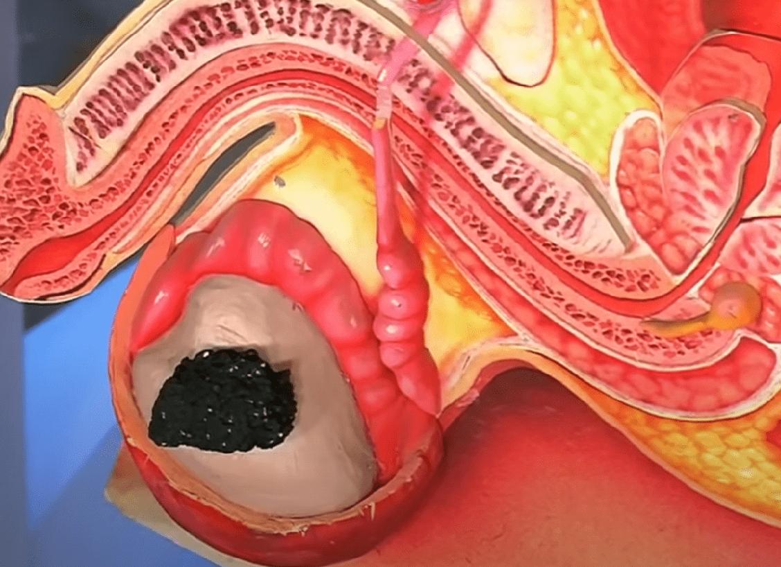 Эмбриональный рак яичка