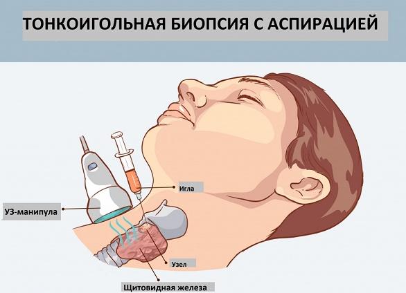 Что такое пункция щитовидной железы Что такое пункция щитовидной железы