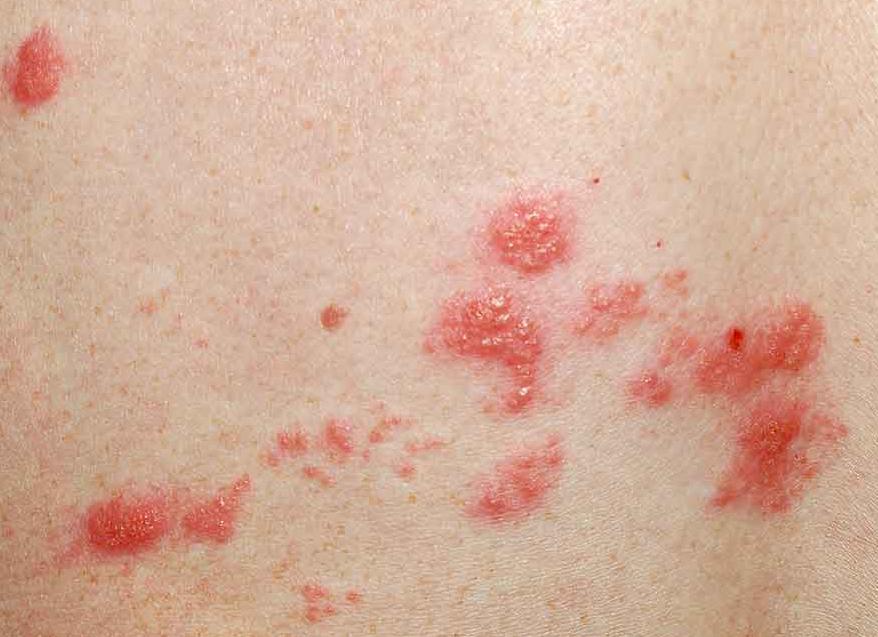 Что это такое герпес в крови