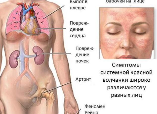 Болезнь волчанка почки