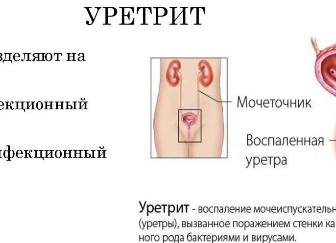 Боль в мочевом канале у женщин