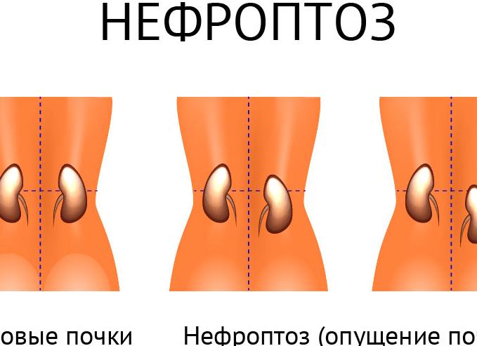 Боль при ходьбе в правом подреберье