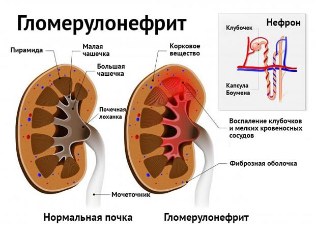 Гломерулонефрит клинические рекомендации