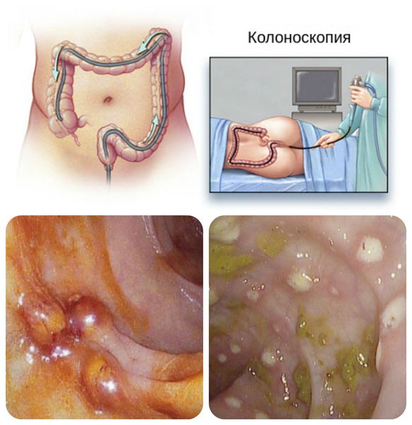 Кишечный амебиаз что это такое
