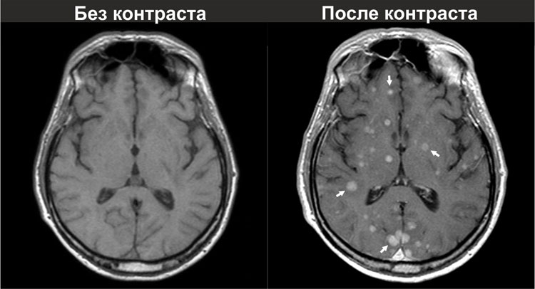 Мрт с контрастом противопоказания