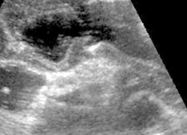 Можно ли увидеть на узи язву желудка