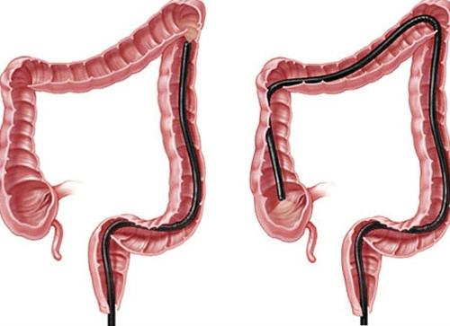 Мониторинговое очищение кишечника Мониторинговое очищение кишечника