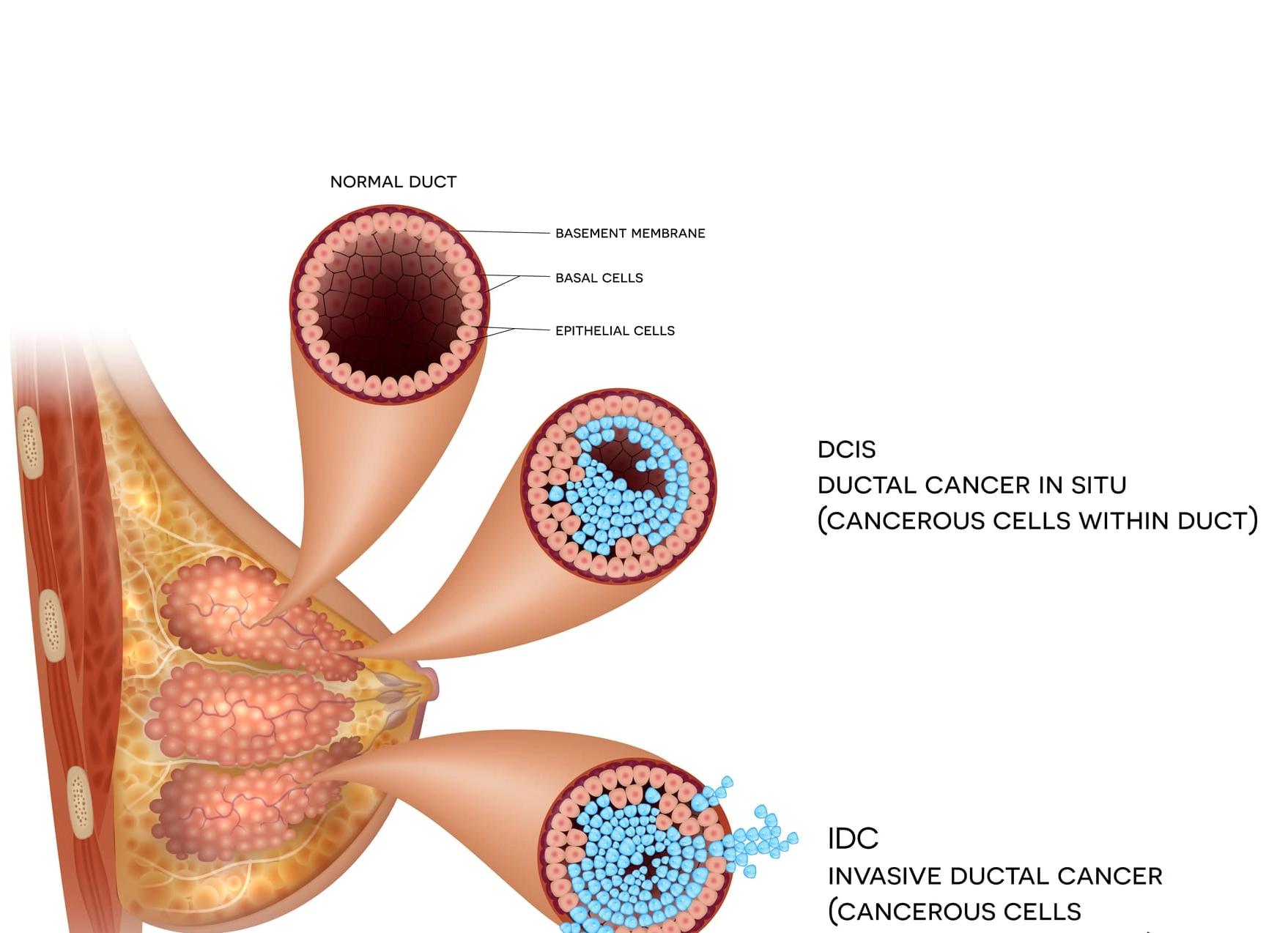 Инфильтрирующий протоковый рак