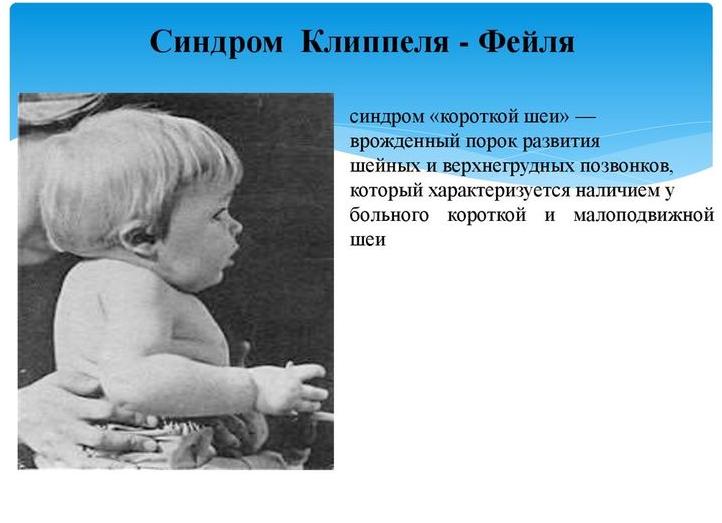 Фото синдром клиппеля фейля