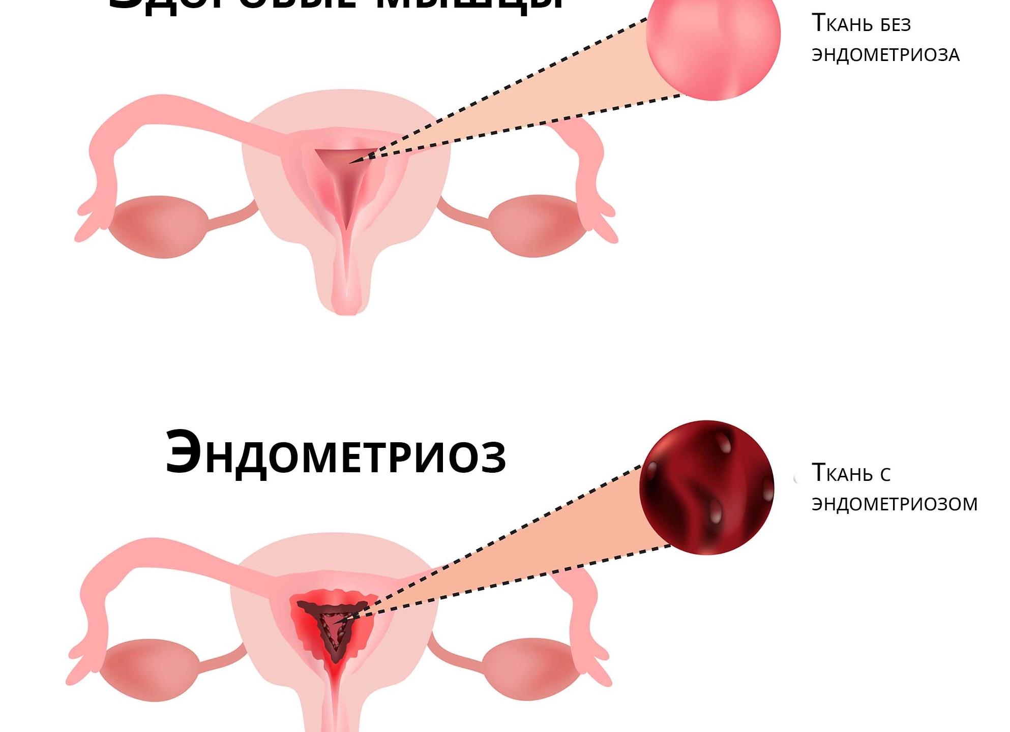 Эндометрия матки норма при менопаузе