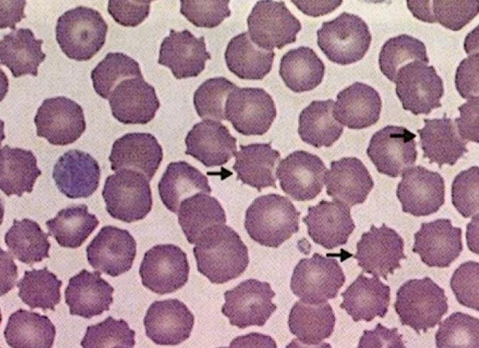 Эхиноциты в крови