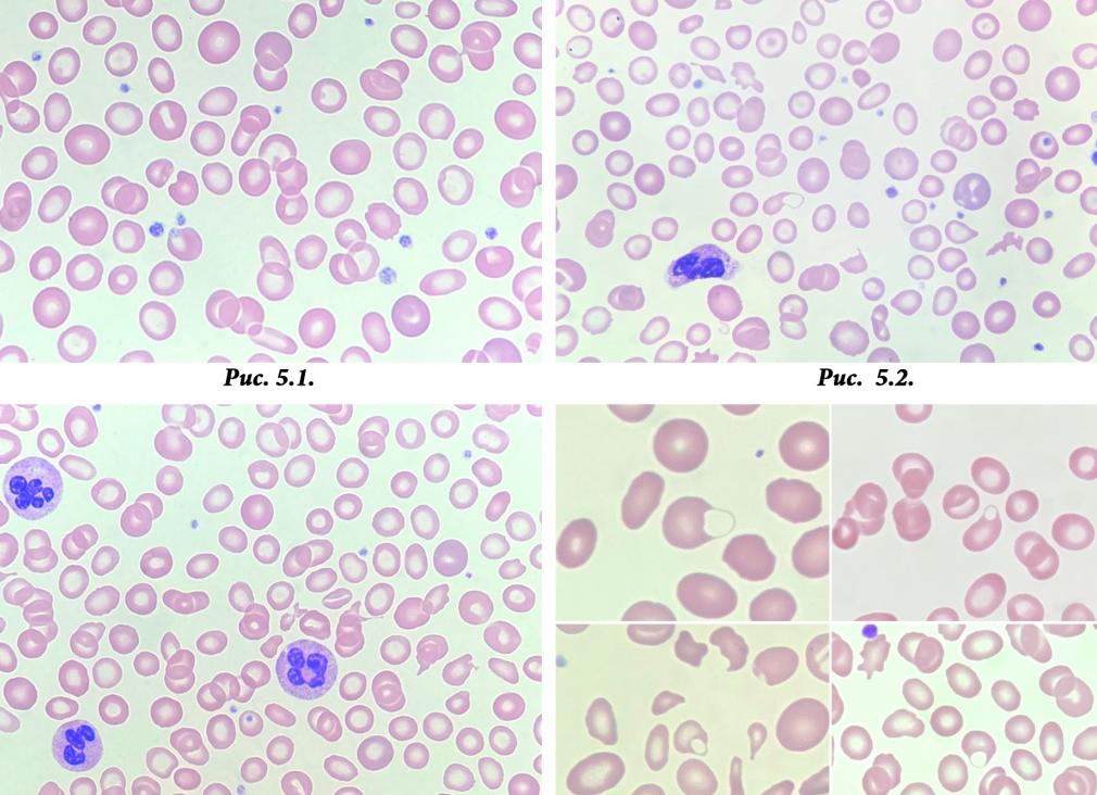 Что такое гипохромия в анализе крови