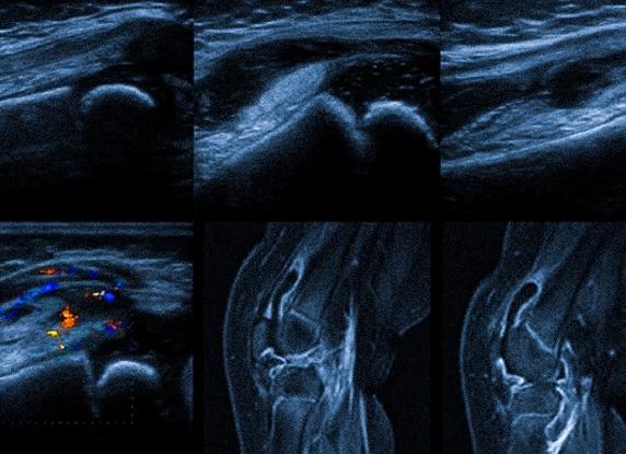 Что дает узи коленного сустава