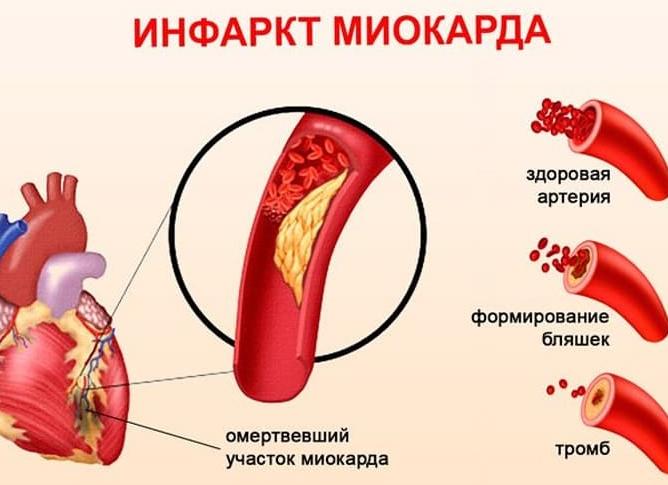 Боль слева в груди причины