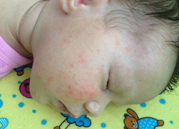 Аллергия на лимон у ребенка Аллергия на лимон у ребенка