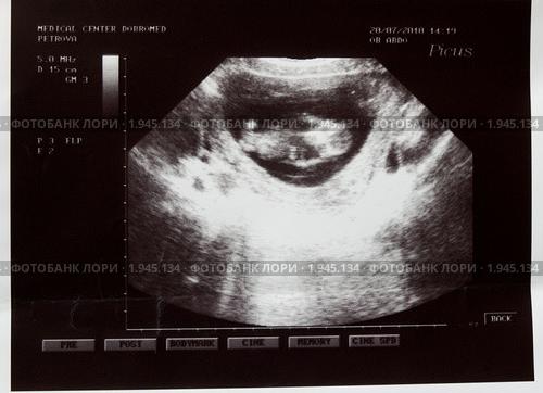 3 месяца узи