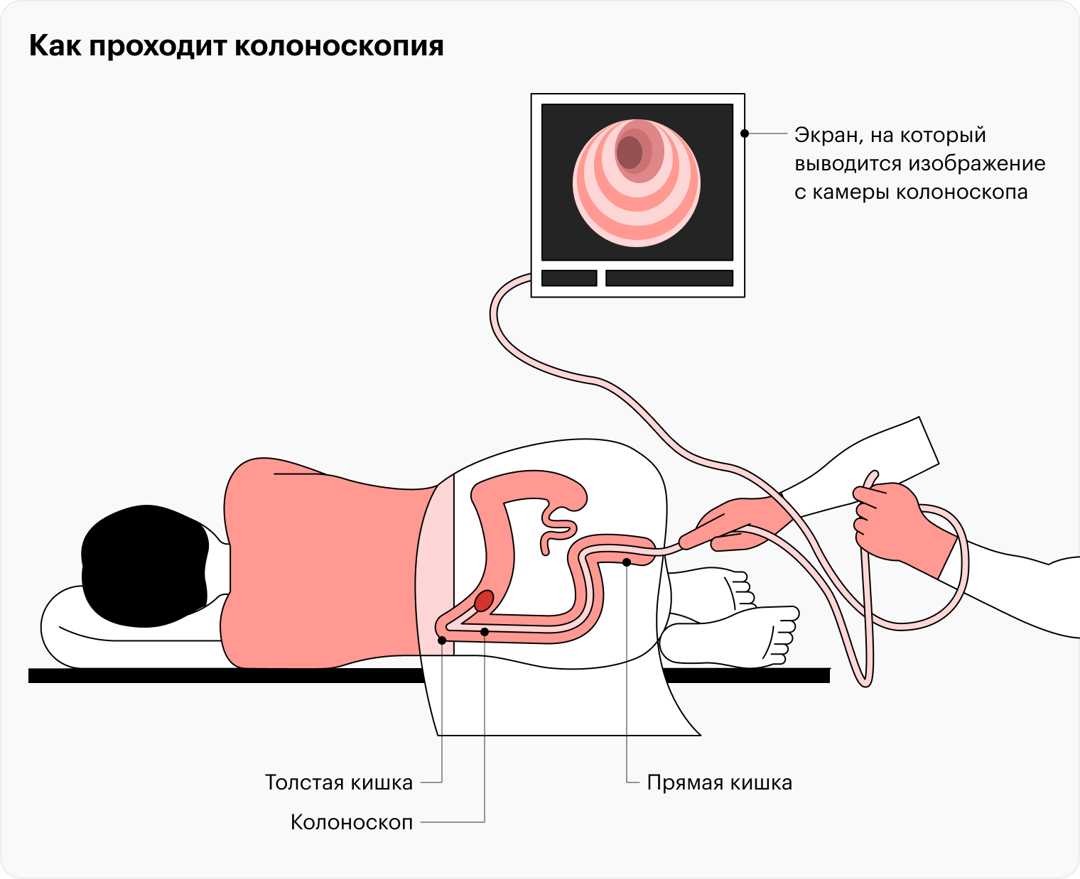 Как подготовиться к процедуре колоноскопия