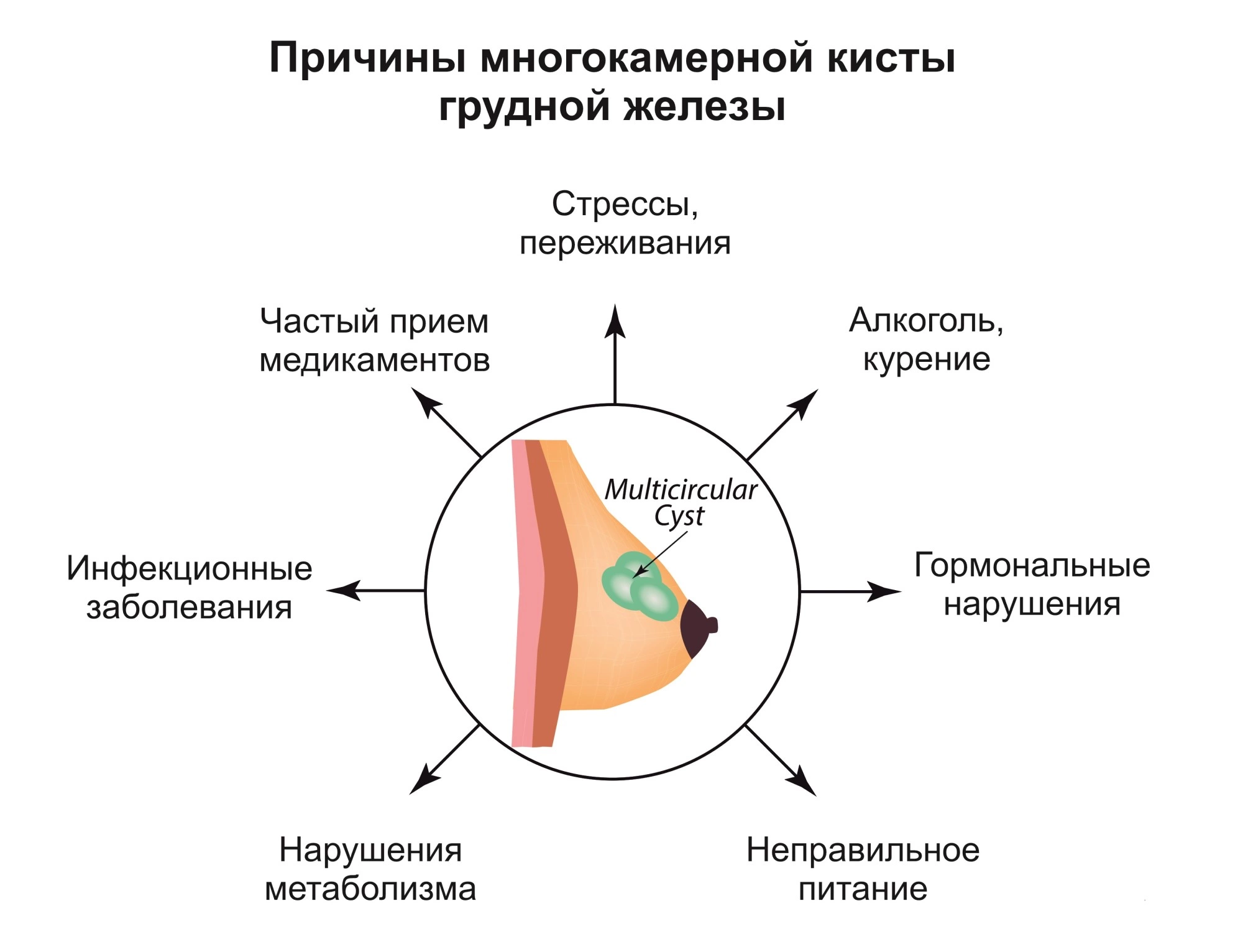 Киста в молочной железе что делать