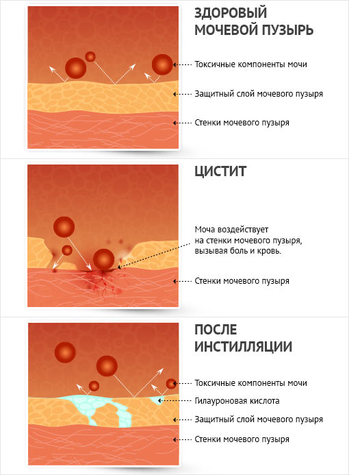 Кровь в моче у женщин