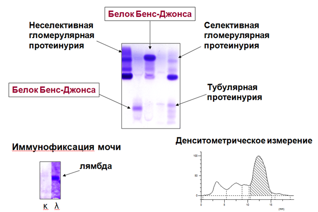 Миеломная болезнь белок бенс джонса