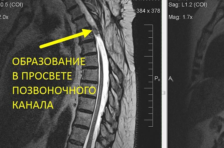 Мрт грудного отдела