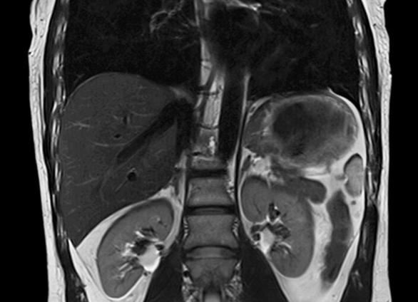 Мрт внутренних органов брюшной полости что показывает