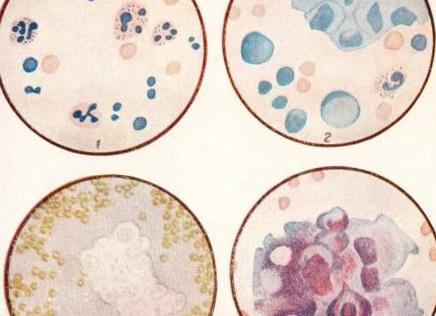 Микроскопия осадка мочи