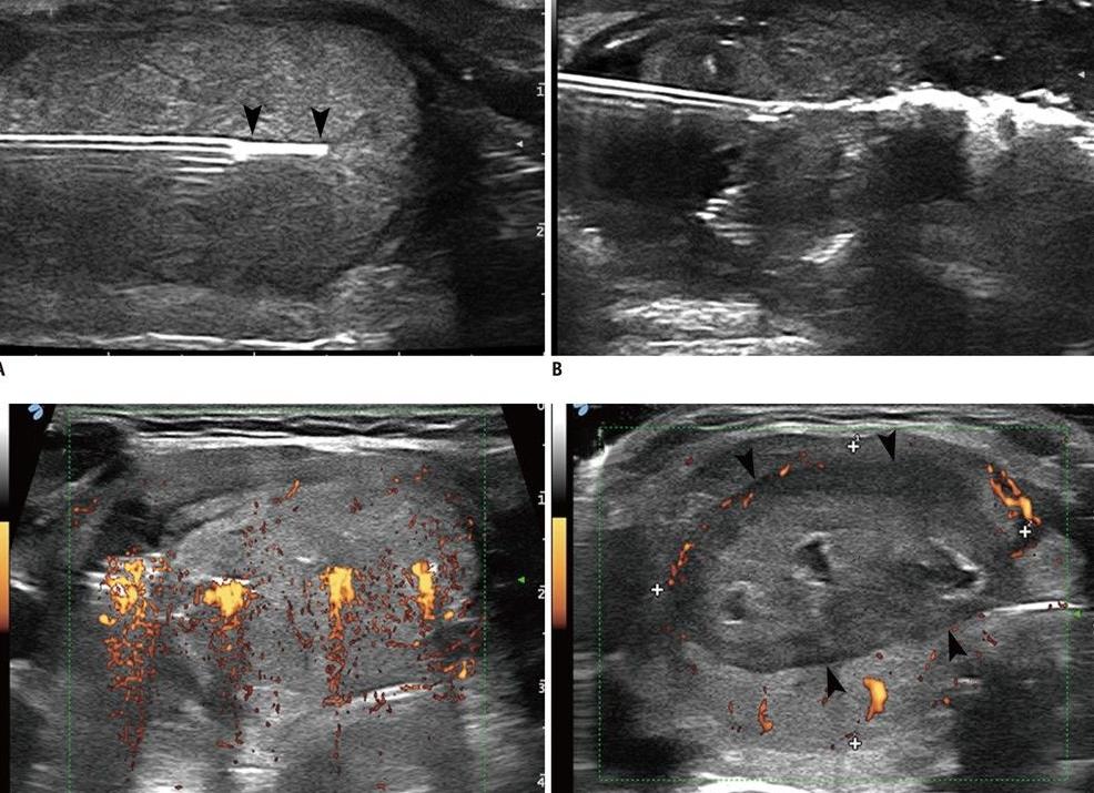 Лазерная деструкция узлов щитовидной железы Лазерная деструкция узлов щитовидной железы