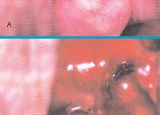 Киста шейки матки в цервикальном канале