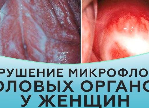 Что такое микрофлора у женщин