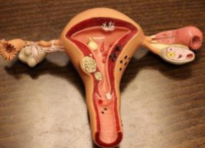 Что такое киста эндоцервикса