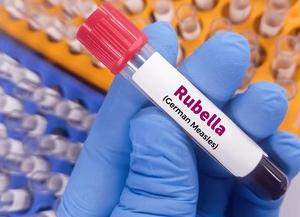 Анализы ат краснуха