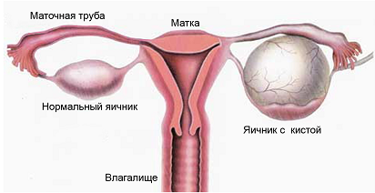 Как проявляется киста на яичнике