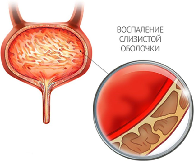 Кровь в моче при цистите что это