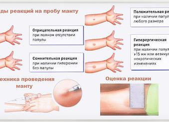 Манту у ребенка норма