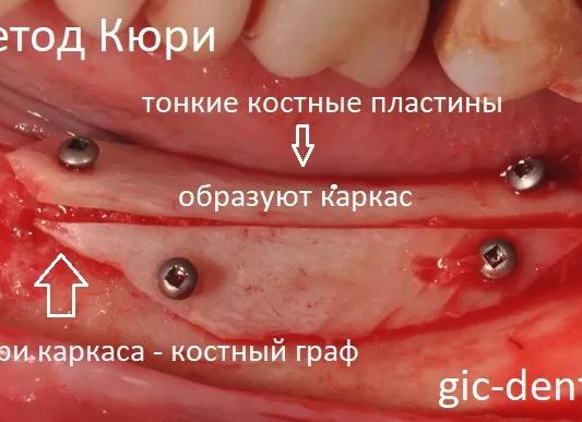 Костные пластинки это
