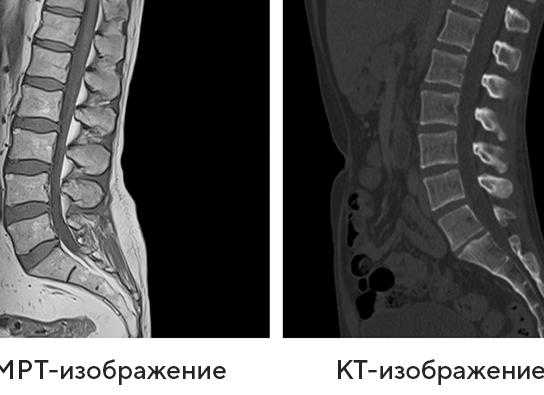 Компьютерная томография позвоночника что это такое