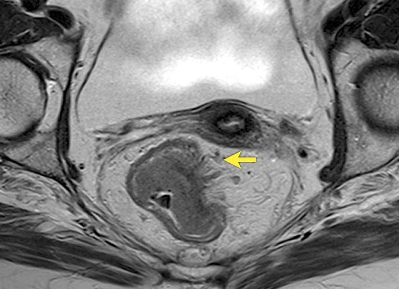 Исследование кишечника с помощью мрт
