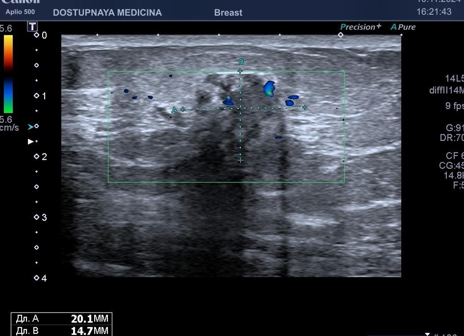 Гипоэхогенное образование в простате что это такое Гипоэхогенное образование в простате что это такое