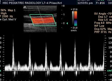 Доплер и дуплекс