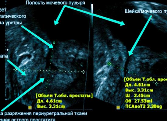 Что показывает узи простаты