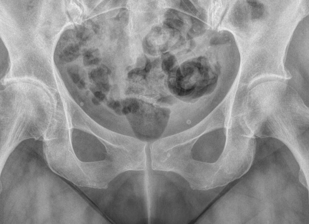 Что показывает рентген тазобедренного сустава
