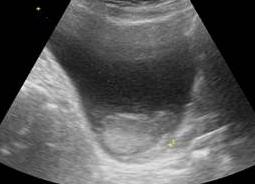 Что покажет узи мочевого пузыря