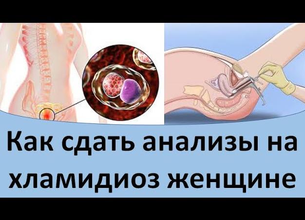 Анализы на хламидиоз у женщин